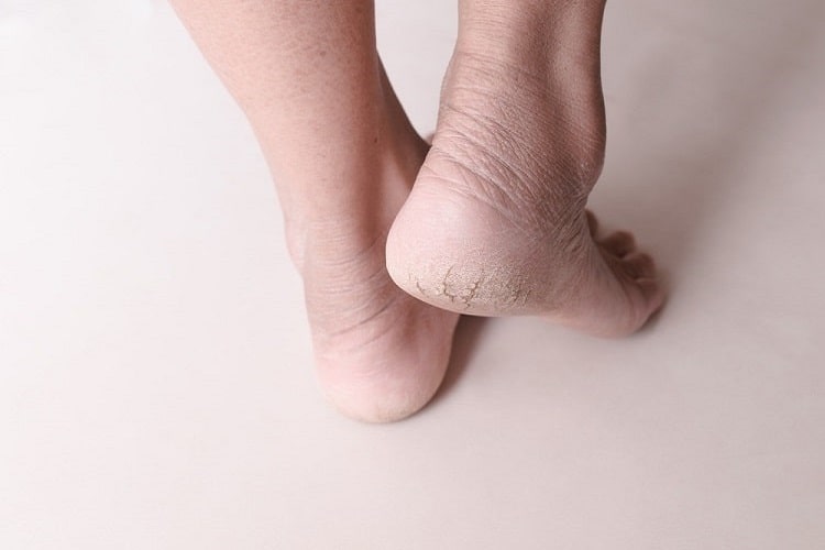 विटामिन ई के फायदे फटी एड़ियों को ठीक करने में - Vitamin E for cracked heel in Hindi
