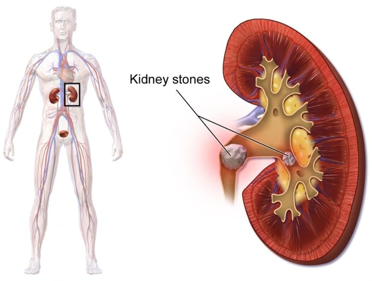 अधिक दही खाने के नुकसान से किडनी का स्टोन हो सकता है - Eating excess Curd May cause kidney stones in Hindi