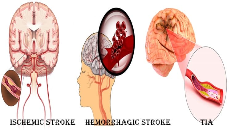 स्ट्रोक के प्रकार - Types of stroke in Hindi