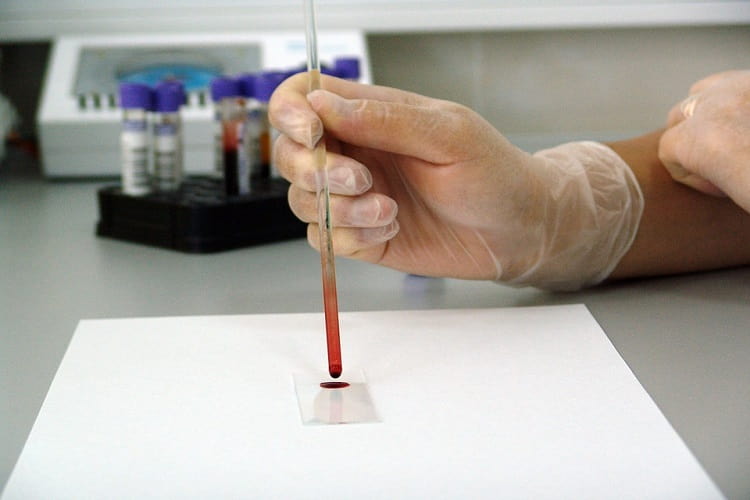 एचआईवी टेस्ट की प्रक्रिया - HIV Test Procedure In Hindi