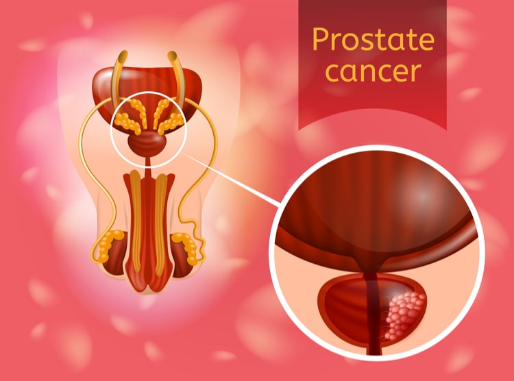 प्रोस्टेट कैंसर क्या है, कारण, लक्षण, जांच और इलाज - What is Prostate Cancer in Hindi