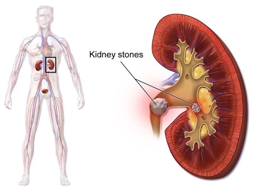 क्रोनिक किडनी डिजीज - Chronic kidney disease in hindi