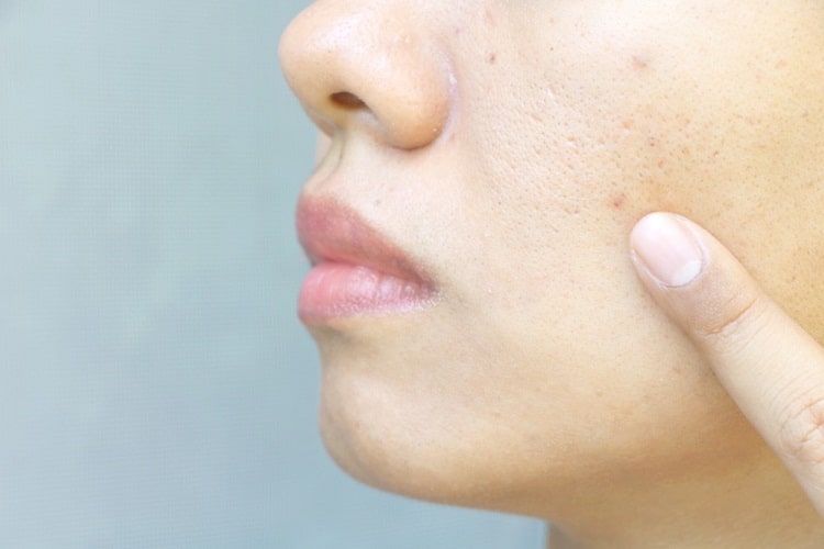 चेहरे के रोम छिद्र बंद करने के उपाय - Skin Open Pores Treatment In Hindi