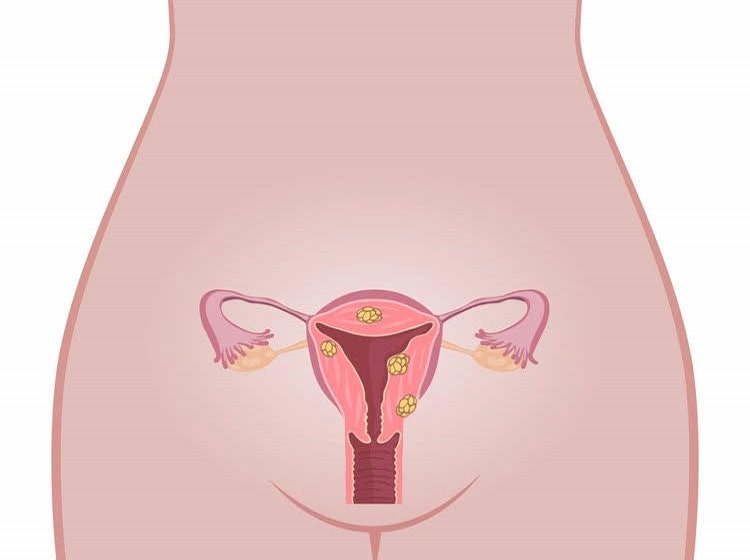 मिसकैरेज के कारण गर्भाशय संबंधी समस्याएं - Uterine problems Causes miscarriage in Hindi