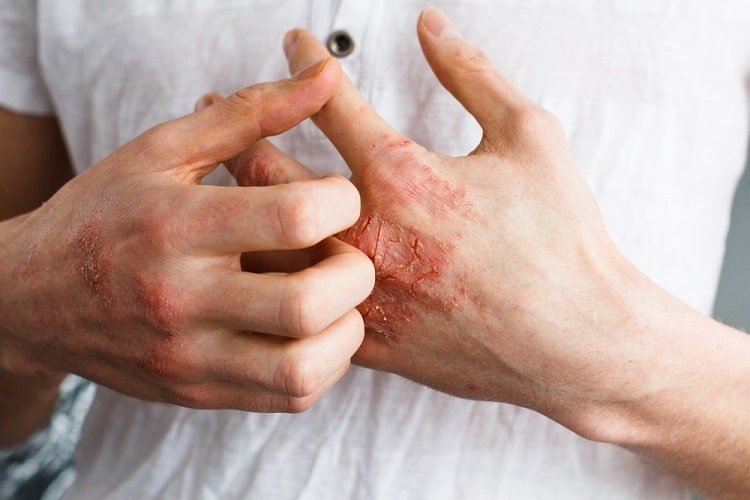 तुलसी के लाभ विटिलिगो और एक्जिमा के लिए – Basil Leaves Treats Vitiligo And Eczema In Hindi