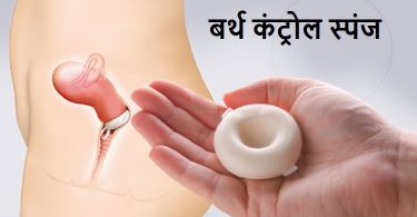 बर्थ कंट्रोल स्पंज का उपयोग, तरीका, फायदे और नुकसान - Birth Control Sponge in Hindi