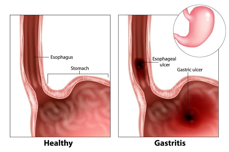 पेट में सूजन (गेस्ट्राइटिस) क्या है – What is Gastritis in Hindi