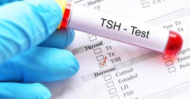 थाइरोइड स्टिमुलेटिंग हार्मोन टेस्ट, प्रक्रिया, रिजल्ट और कीमत - TSH (Thyroid-stimulating hormone) Test Procedure, Results and Price in Hindi