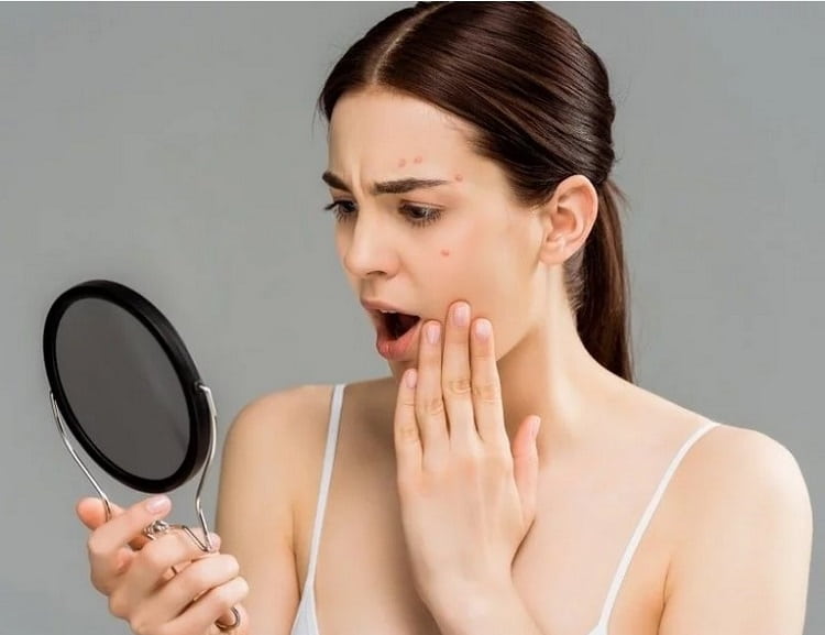 होठों पर मुंहासों का इलाज - Treatment of lip pimple in Hindi