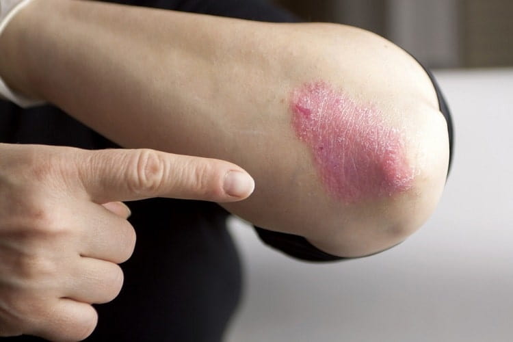 हाथ पैरों में झनझनाहट या सुन्नता का कारण ल्यूपस – Numb and Tingling hands and feet causes Lupus in Hindi