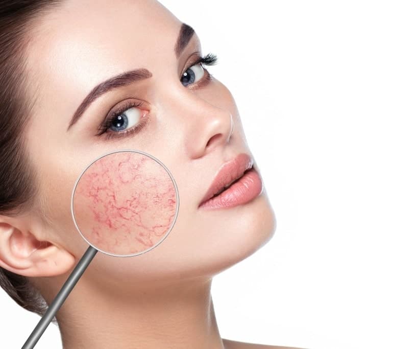 चेहरे पर लालिमा का कारण क्या है - What Causes Redness On The Face in Hindi