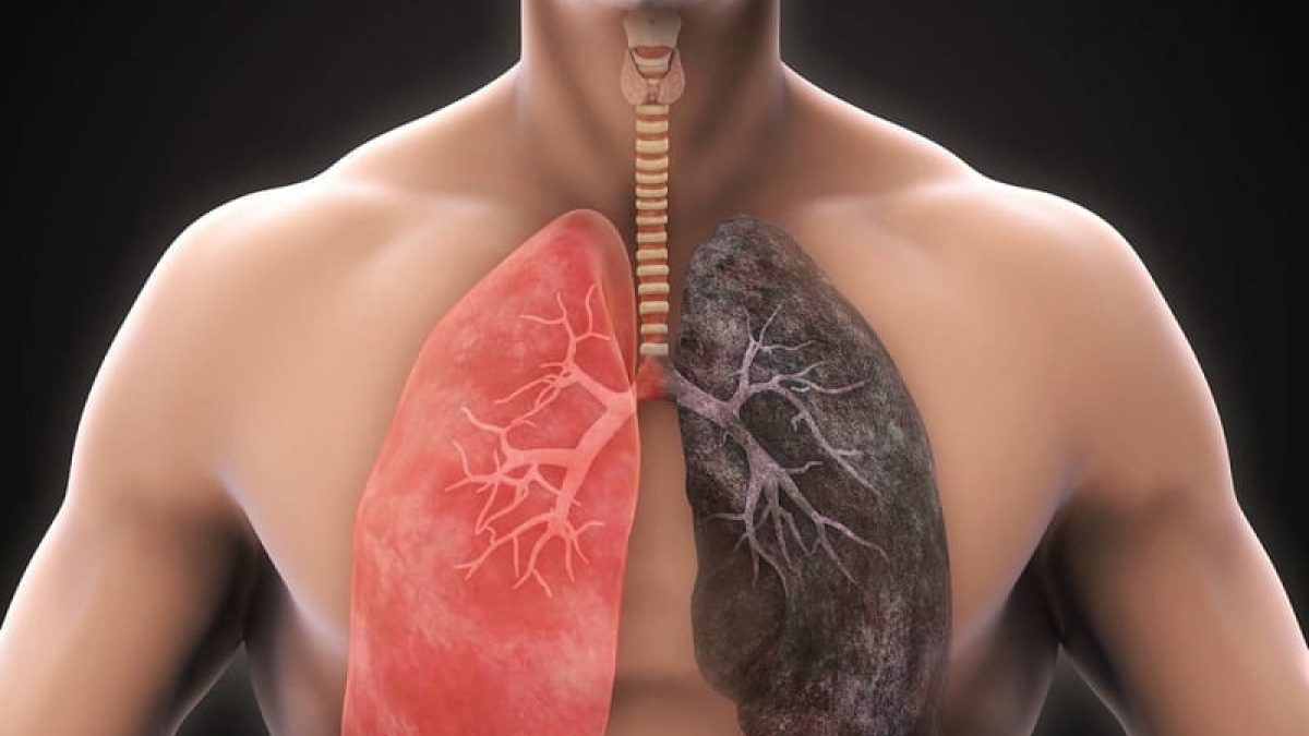 फेफड़े के रोग, कारण, लक्षण, जांच, इलाज और बचाव - Lung Diseases causes,  symptoms, test, treatment and prevention in Hindi