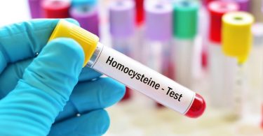 होमोसिस्टीन टेस्ट क्या है और इसका नार्मल लेवल कितना होना चाहिए - Homocysteine Test Levels, Result Meaning, and Function in Hindi