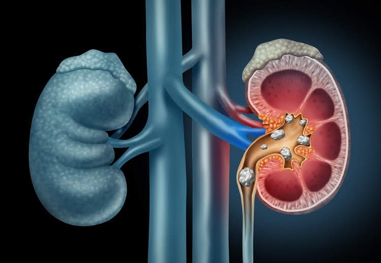 किडनी स्टोन क्या है? - What are kidney stones in Hindi