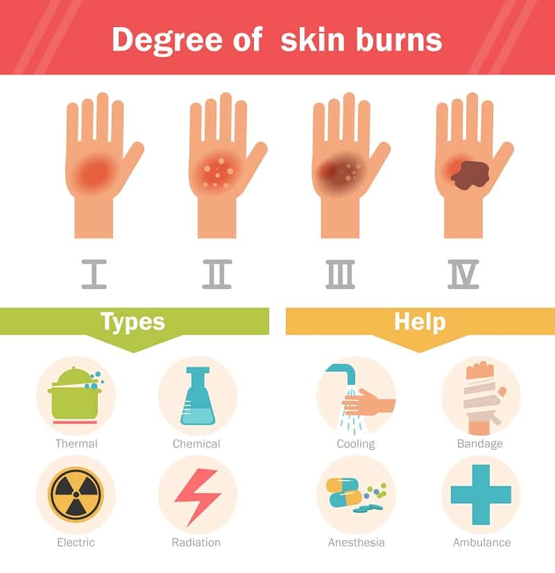 जलने के प्रकार - Types of burn in Hindi