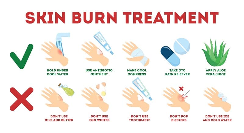जलने के घरेलू उपाय - Home remedies to treat burns naturally in Hindi
