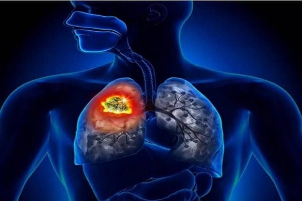 लंग कैंसर के शुरुआती लक्षण - Lungs Cancer Ke Shuruati Lakshan - Healthunbox