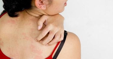 स्किन एलर्जी के कारण लक्षण जाँच और इलाज – Skin allergy causes, symptoms, test and treatment in hindi