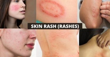 त्वचा पर चकत्ते (स्किन रैशेज) के कारण, लक्षण और घरेलू इलाज - Skin rash (Rashes) Causes Treatment in Hindi