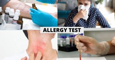 एलर्जी टेस्ट क्या है, कब कराएं और रिजल्ट - Allergy test in Hindi