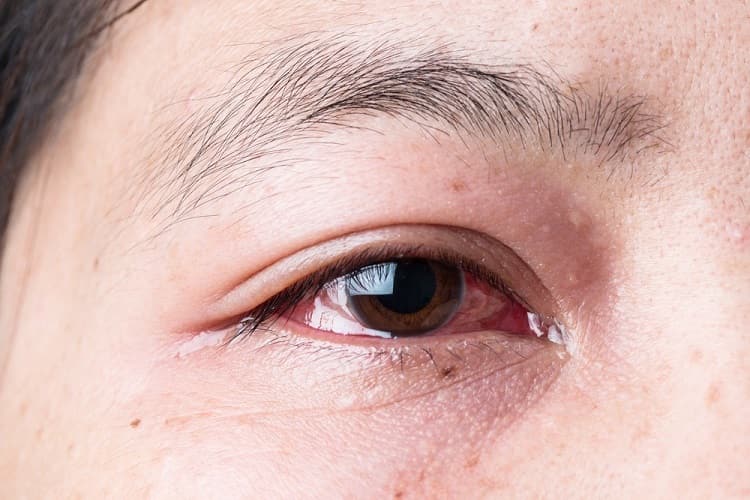 आँख में गुहेरी होने के लक्षण – Stye eye symptoms in Hindi