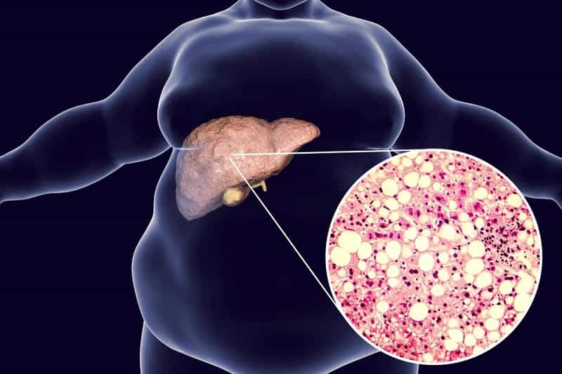 फैटी लिवर रोग - Fatty liver disease in Hindi  