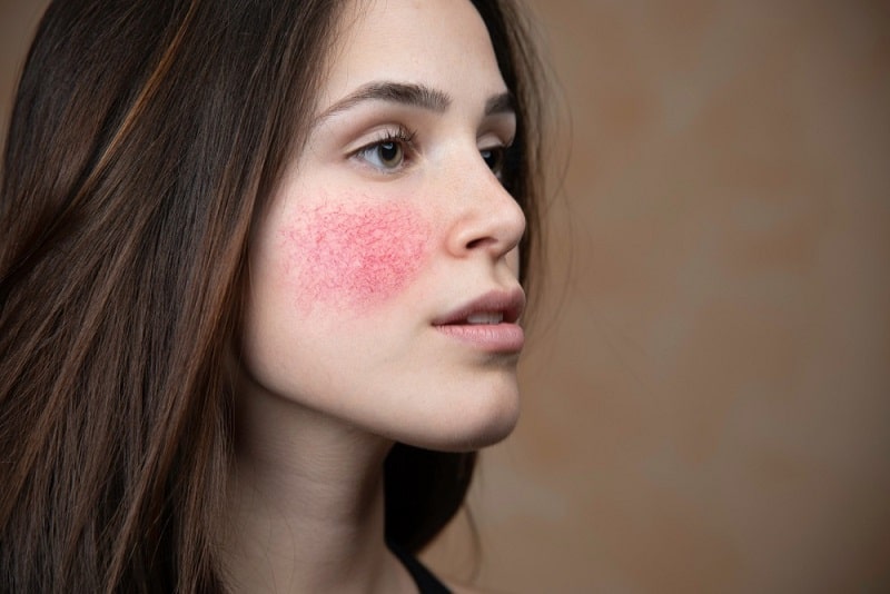 त्वचा पर चकत्ते के सामान्य कारण - Common causes of Skin rash in Hindi
