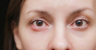 गुहेरी (बिलनी) के कारण, लक्षण, इलाज और बचाव - Stye Eye (hordeolum) causes, symptoms, treatment in Hindi