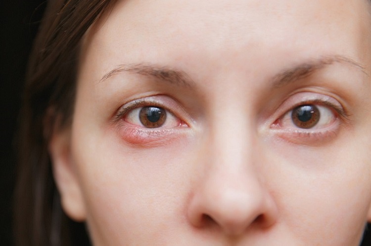 गुहेरी (बिलनी) के कारण, लक्षण, इलाज और बचाव - Stye Eye (hordeolum) causes, symptoms, treatment in Hindi